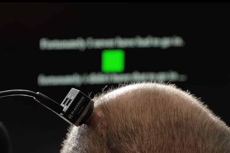 Brain implant breakthrough helps ALS man talk – and sing – again